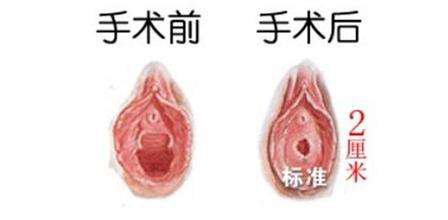 处女膜修复挂什么科