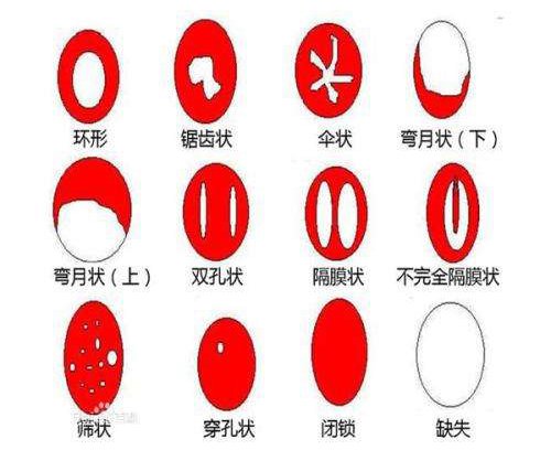 处女膜修复手术