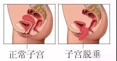 盆底肌如何修复？