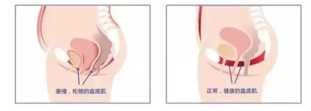 盆底肌如何修复？
