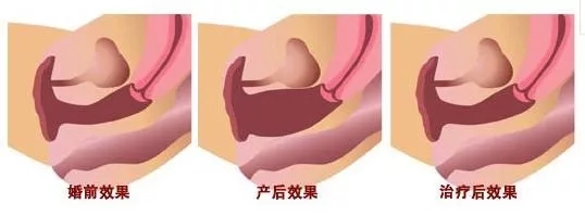 产后松弛不性福？菲蜜丽让你做回紧致小女人